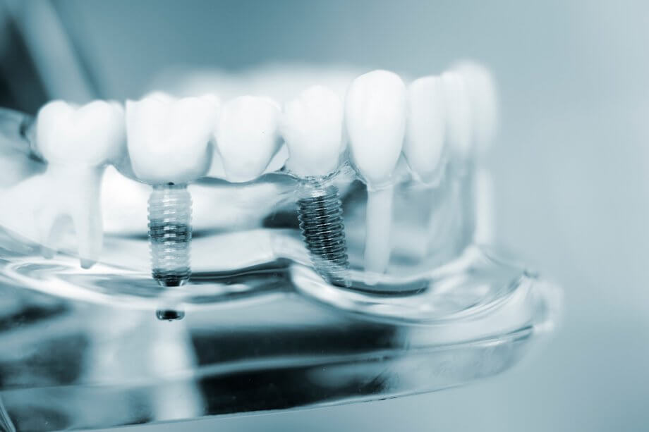 Can Dental Implants Be Done In One Day?