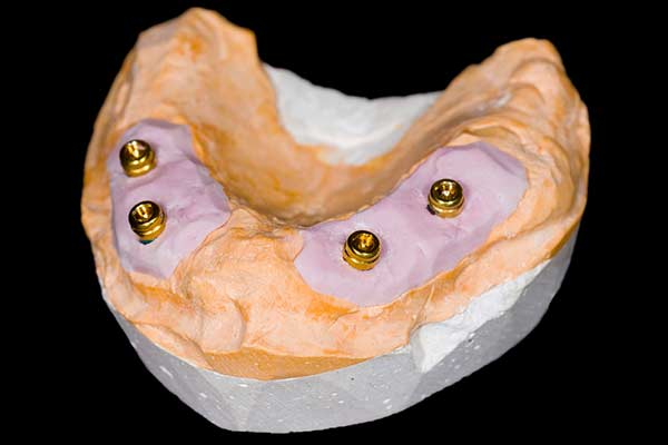 Four Implants in Lower Jaw Model