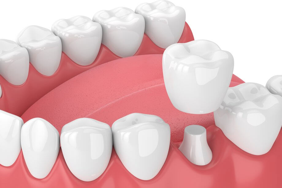 How Much Do Dental Crowns Cost In Germantown, MD?