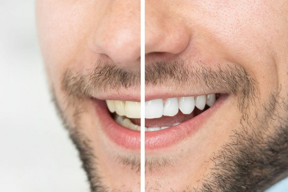 before and after of man smiling after teeth whitening