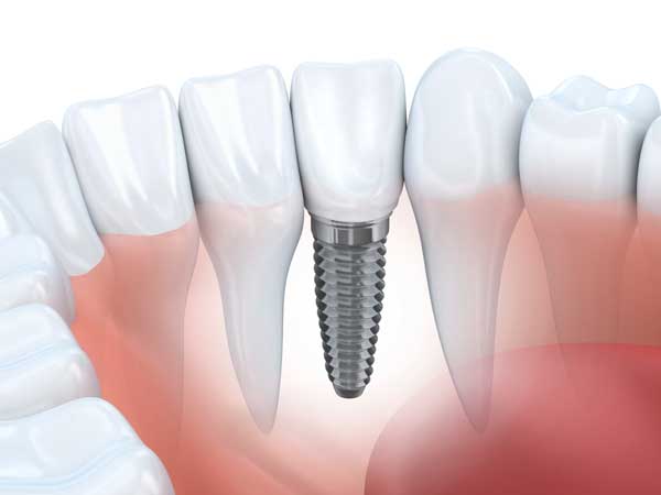 Dental Implant Graphic