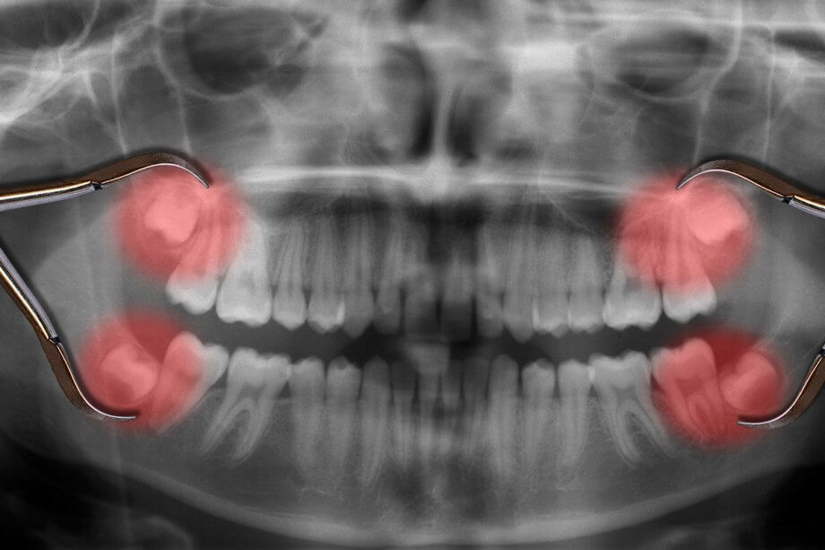 What to Expect After Wisdom Tooth Extraction